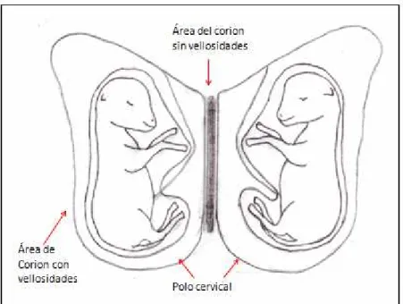 Figura Nº 1: ubicación de mellizos dentro del útero, visto desde arriba (dorsal), la  superficie placentaria donde ambas placentas se ponen en contacto carece de  vellosidades coriónicas
