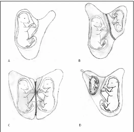 Figura Nº 2: cuando en el útero existe un solo feto, la placenta ocupa el cuerpo del  útero y ambos cuernos (A)