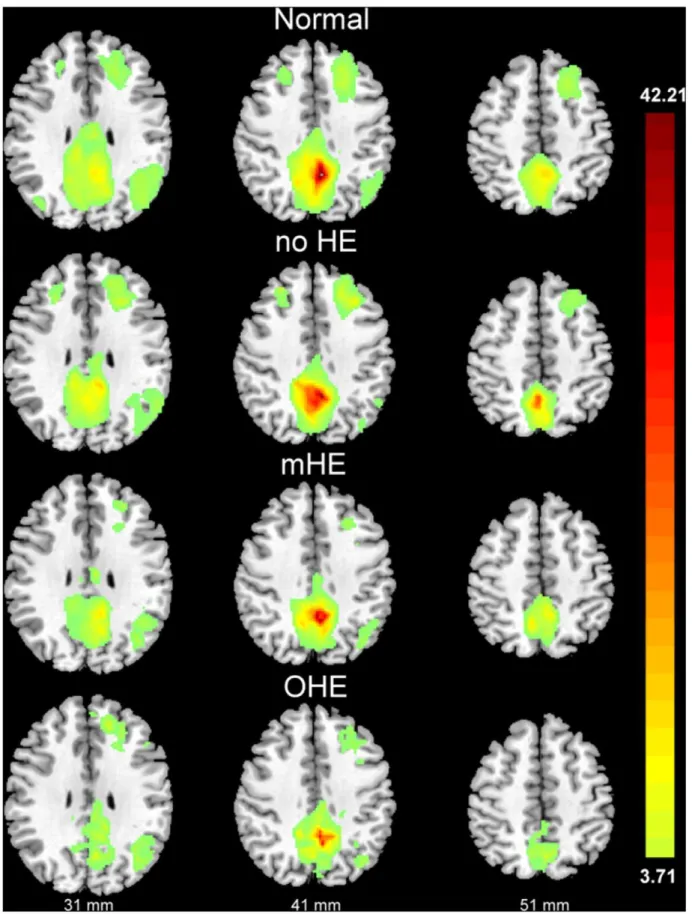 Figure 1. The fc-fMRI values relative to the PCC seed region. There were significant fc-fMRI values relative to the PCC seed region in the normal control, no hepatic encephalopathy (HE), minimal HE (mHE), and overt HE (OHE) groups at p,0.001 (corrected for