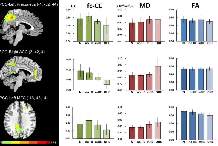 Table 2. Regions showing differences in fc-fMRI between normal subjects and cirrhotic patients in the PCC functional connectivity map.