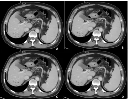Fig 1. Enhanced axial images at portal venous phase of a 63-year female patient with portal