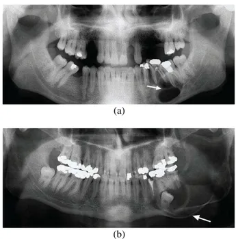 Fig. 1. The cyst and tumor lesion on dental panoramic images. (a) cyst  lesion (arrow), (b) tumor lesion (arrow)