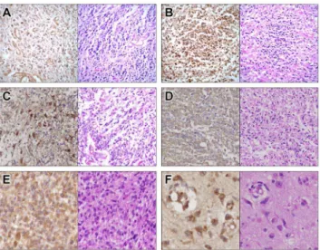 Figure 5. OLIG2 , PARD3 and EFNB3 expression in GBM patients.