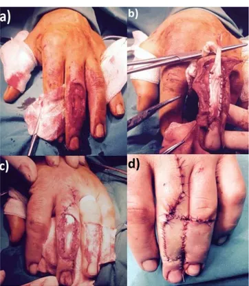 Figure 1. (a) Irrigated and meticulously debridated wound shows 3rd inger exten- exten-sor tendon zones Dd1, Dd2 and Dd3 defects with total tendon loss