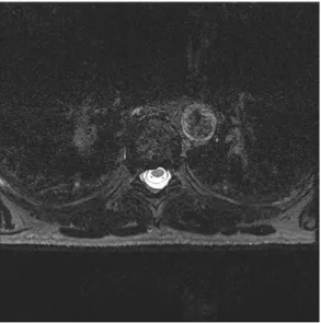Figure 1.Nuclear magnetic resonance myelography of thoracic  spine  of  the  patient  showing  small  pocket  of  liquor  in  front  of the 7th and 8th thoracic vertebra (University Hospital Clinic  Dubrava, Zagreb, Croatia, 2011)