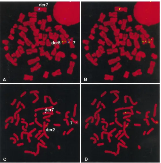Figure 4 Two-color FISH analyses of translocations in patients with speech and language disorder, using BACs from 7q31