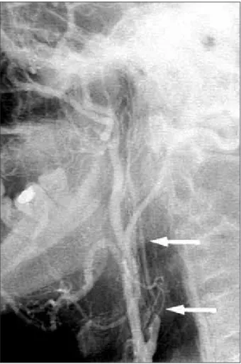 Figure 5. Control angiogram repeated on second hospitalisation