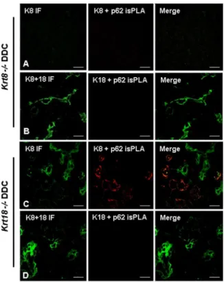 Figure 6. isPLA and IF for 12 week-DDC treated krt8 2/2 and krt18 2/2 mice. (A, B) krt8 2/2 mouse liver