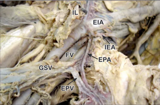 Figure 3. Dissection of right obturator canal. (VOV: variant obturator  vein;  VOA:  variant  obturator  artery;  ON:  obturator  nerve;  OV: 