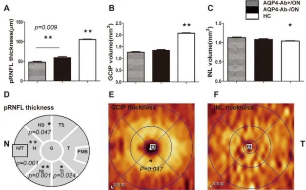Fig 3. Quantification and spatial comparisons of pRNFL and segmented macular layers in AQP4-Ab-positive ON and AQP4-Ab-negative ON eyes without an ON attack for 6 months