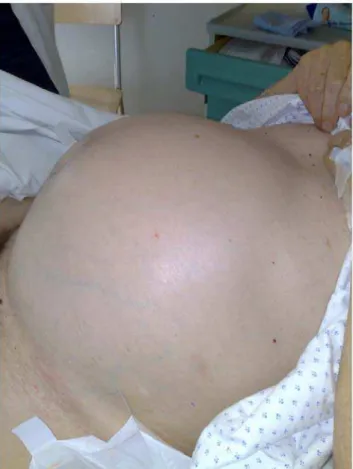 Figure 5. Abdominal CT scan with multiplanar reconstruction showing the persistence of a large faecal impaction, over 18 cm in extent, located in the sigmoid colon, as well as a massive dilatation of the colonic wall and the descending sigmoid colon formin