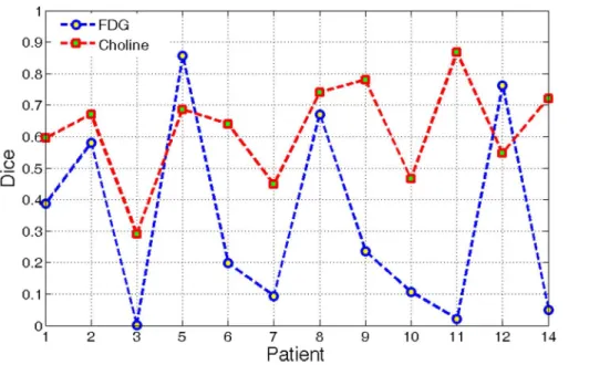 Fig 2. DSC of RG results using FDG and Choline PET/CT fusion.