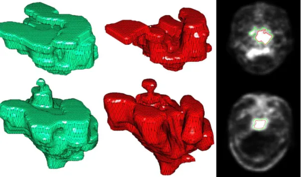 Fig 3. Solid rendering of manually contoured reference (green) and RG result (red). The first row shows the result of 18 F-FDG; the second row shows the result of 11 C-Choline
