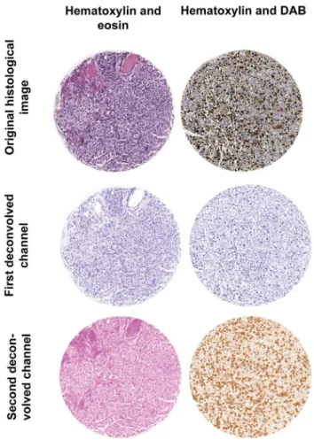 Figure 1. Dye separation. Using the color deconvolution plugin, an image of a tissue cores double stained with a counter staining dye (e.g.