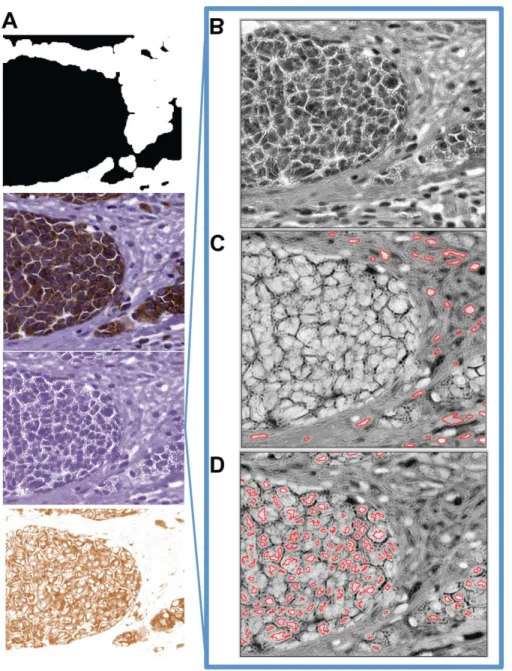 Figure 3. Cell nuclei segmentation of Melan-A stained TMAs tissue spot images. The CellProfiler ruleset take as input the original IHC stained tissue core image as well as the Melan-A binary mask (A)