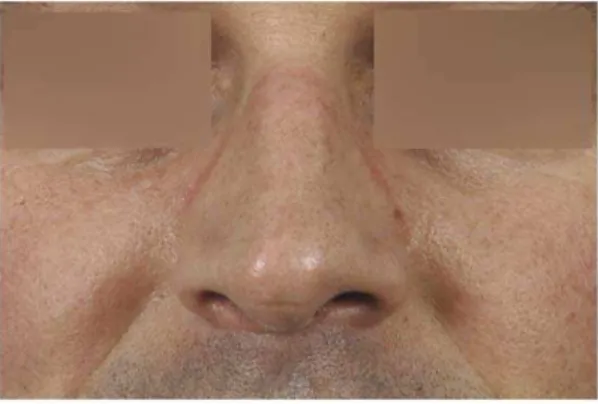 Figure 4. During an NVG-free period the nasal haematoma and swelling are absent in the same pilot (compare with Figure 3).
