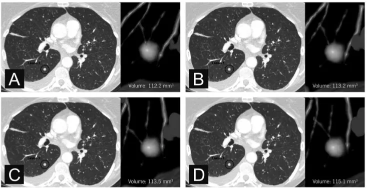 Figure 1. Axial CT images of a small pulmonary nodule. Measured volumes were 112.2 mm 3 (A, FBP), 113.2 mm 3 (B, iDose 4 level 2), 113.5 mm 3 (C, iDose 4 level 4), and 115.1 mm 3 (D, iDose 4 level 6).