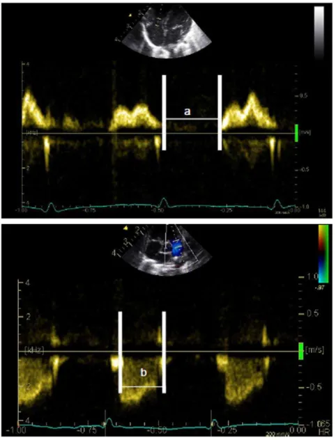 Figure 2. Doppler methodology. Measurement of the myocardial performance index by pulsed Doppler in the right ventricle capturing inflow and outflow