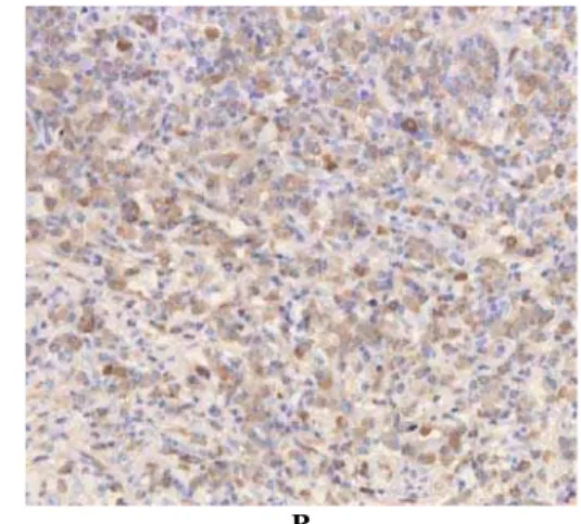 Fig. 3 – Histological findings of lacrimal gland biopsies. Immunohistochemical staining showing: A) IgG4- IgG4-positive plasma cells, and B) IgG-IgG4-positive plasma cells in the lacrimal gland section of the patient (200)