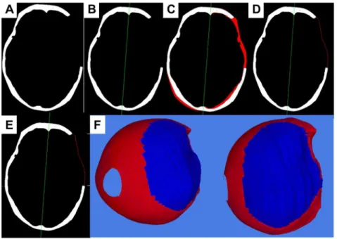 Figure 2. Verifying 3-D skull model reconstruction using CIS score of case 10. 3-D CT reconstructions were rotated as in a vertex view, with face up (double arrow) and in occipital inferior (single arrow) position