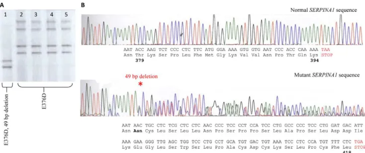 Figure 1. Identification of a novel SerpinA1 Mutant. A. DGGE banding patterns representing four controls (lanes 2–5) heterozygous for the M3 mutation (E376D), while our patient (lane 1), although also heterozygous for the M3 variant also presents with a sh
