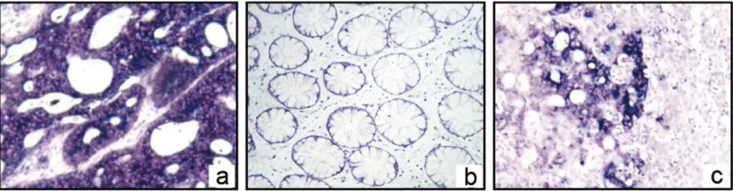 Figure 1. OPN mRNA location in CRC and its liver metastasis with in situ mRNA hybridization