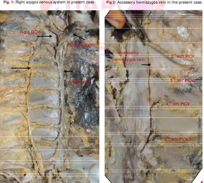 Fig. 1:  Right  azygos venous syst em  in present  case. Fig 2:  Accessor y hem iazygos vein in t he present  case.