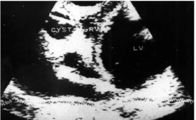 FIGURE 3. Echocardiographic finding of tricuspidal valve changes due to empИ tied hidatid cyst.