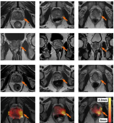 Fig 5. Results for three patients (one per column). The first row represents the pre-treament MRI scan (I Pre )