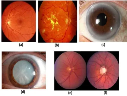 Figure 1: Various type of ocular diseases 