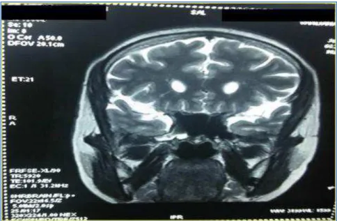 Fig. 2: MRI brain Showing, 1. 2 mm sized defect in lateral wall of  Sphenoid on Right side with communication between sphenoid and 