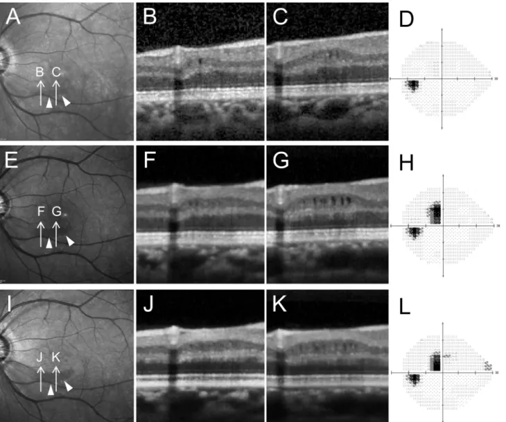 Fig 5. Changes over time in an eye with microcystic inner nuclear layer (INL). Changes appearing before significant visual field damage occurred