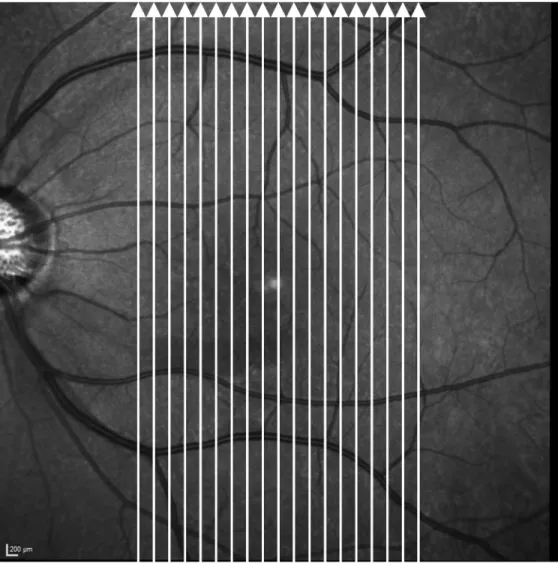 Fig 2. The OCT macular scanning protocol. The protocol consisted of 19 vertical scan lines (white arrows) over macular area