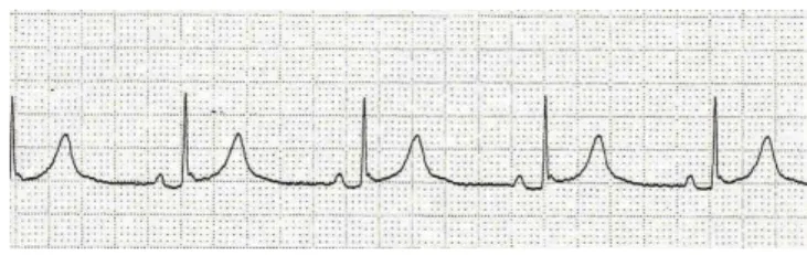 Figure 1. Electrocardiogram shows complete heart block with a ventricular rate of  72 on the day of admission