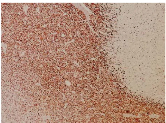 Fig. 4 – Staining for desmin was strongly positive in the area of malignant Triton tumor (peroxidase-antiperoxidase