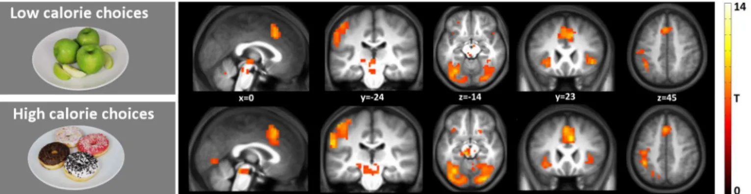 Fig 3. Brain regions with stronger activation in response to HCC and LCC vs baseline. Shown is a T-map thresholded at P<0.05 (FWE-corrected;
