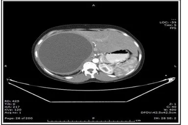 Fig. 1: CECT showing Hydatid cyst in Right lobe of liver 