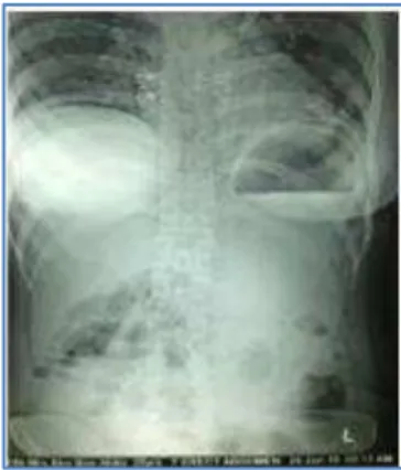 Fig. 1: Air under the right dome of diaphragm