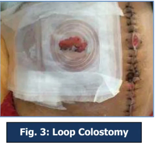 Fig. 3: Loop Colostomy