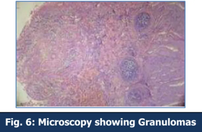 Fig. 6: Microscopy showing Granulomas