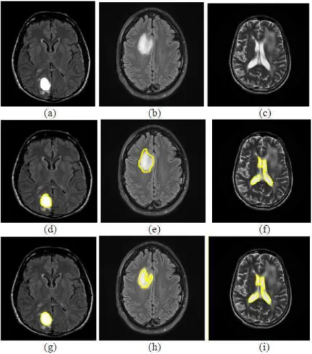 Fig. 6. (a-c) Source images, (d-f) Ground truth images, (g-i) tumour identified images using proposed method