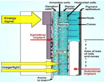 Fig 1: Position of retinal implants inside the eye 