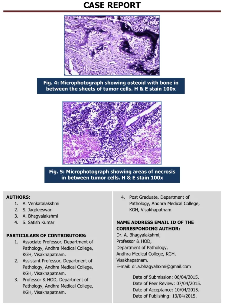 Fig. 4: Microphotograph showing osteoid with bone in  between the sheets of tumor cells