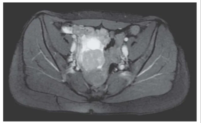 Abbildung 1: MRT-Bild des DSRCT im Bereich des rechten Ovars bei Erstdiagnose.
