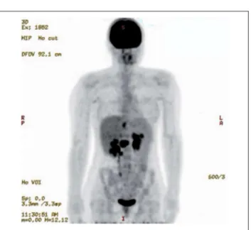 Abbildung 4: Ganzkörper-PET mit mehreren kleinen Tumorknoten im Oberbauch (3. Re- Re-zidiv)