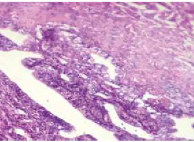 Fig. 2: Gross Photograph Showing  Obliteration of Lumen of Fallopian Tube by a 