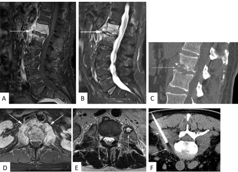 Fig 1. 63 year-old male patient with suspected spondylodiscitis. Sagittal T1-weighted fat-saturated contrast-enhanced sequence (A) demonstrates florid enhancement of adjacent vertebral bodies and paravertebral soft tissue