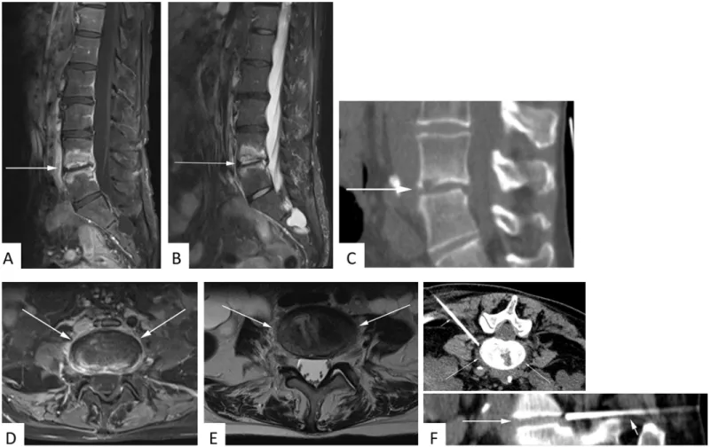 Fig 2. 53 year-old female patient with suspected spondylodiscitis. Sagittal T1-weighted fat-saturated contrast-enhanced sequence (A) again illustrates prominent enhancement of adjacent vertebral bodies but not of paravertebral soft tissue
