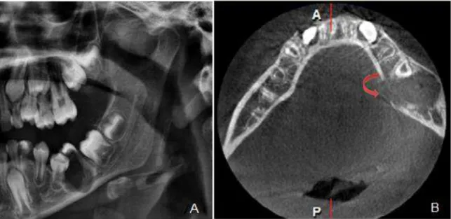 Figure 1. A) Pre-operative OPG demonstrating a radiolucent lesion in the left side. B) Lingual plate absorption  converted to lingual plate perforation 