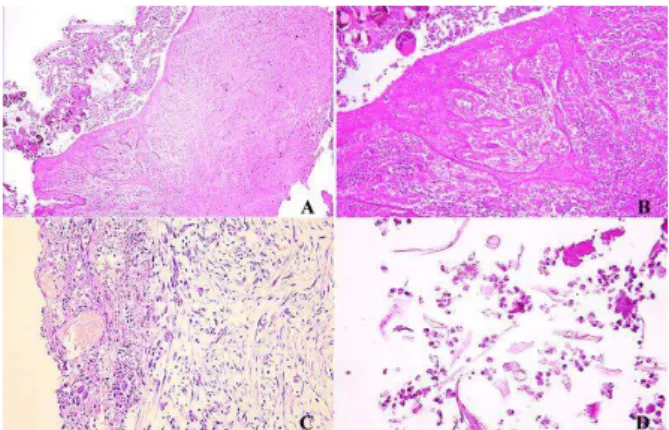 Figure 2. A-D) Initial biopsy revealed neoplastic  proliferation of fibroblasts, several mitosis, a vast  number of blood vessels and foreign body giant cells